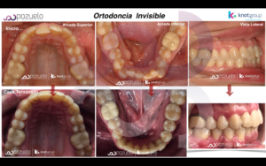 Ortodoncia a domicilio en Madrid